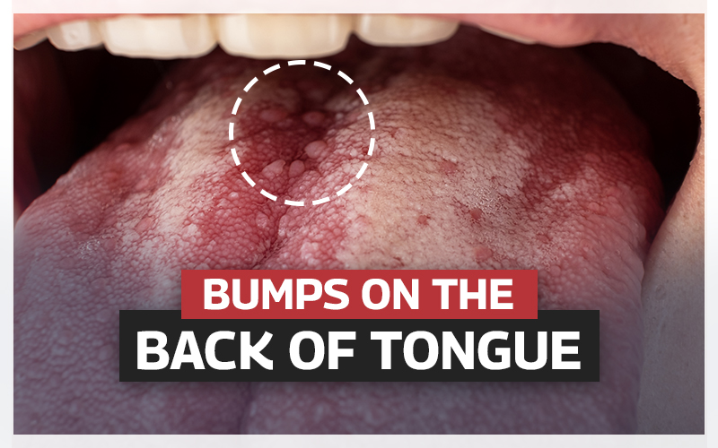 bumps on the back of tongue
