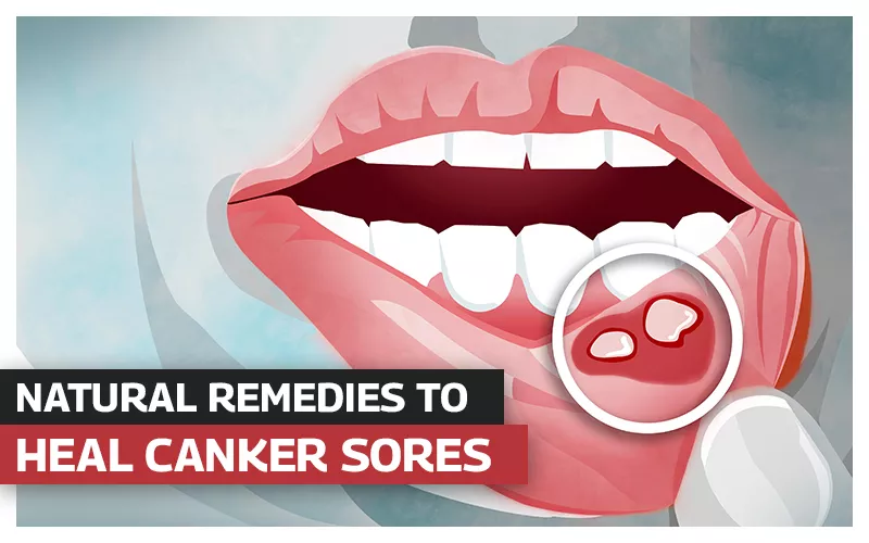 Home Remedies To Heal Canker Sores & Mouth Ulcers